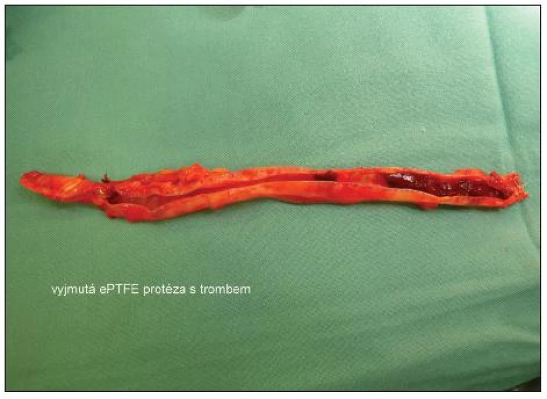 Vyjmutá ePTFE protéza s trombem
Fig. 3. Removed ePTFE prosthesis with thrombus