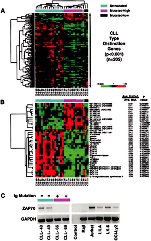 Různě exprimované geny u buněk chronické lymfatické leukemie s mutovaným nebo nemutovaným genem pro těžký řetězec imunoglobulinů (IgVH). Podle: Rosenwald et al., 2001 (37).