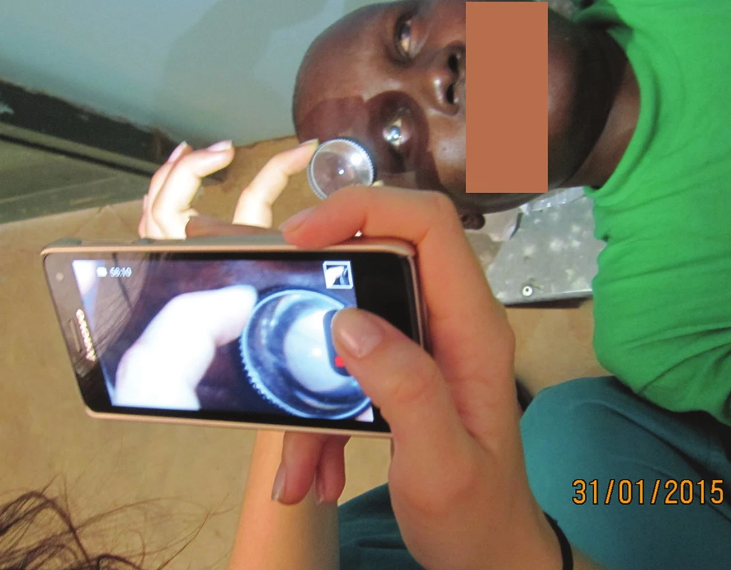 Začiatok vyšetrenia očného pozadia pomocou Volkovej šošovky a smartfónu