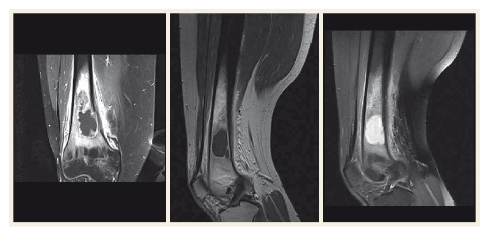 Magnetická rezonance distální diafýzy femuru a pravého kolenního kloubu.
