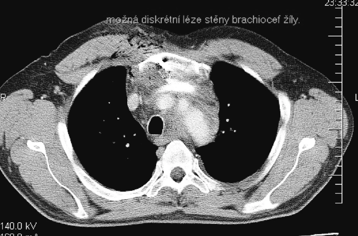 CT nález – Poranenie steny brachiocephalickej žily
Pic. 2. CT finding – Traumatized brachiocephalic venous wall
