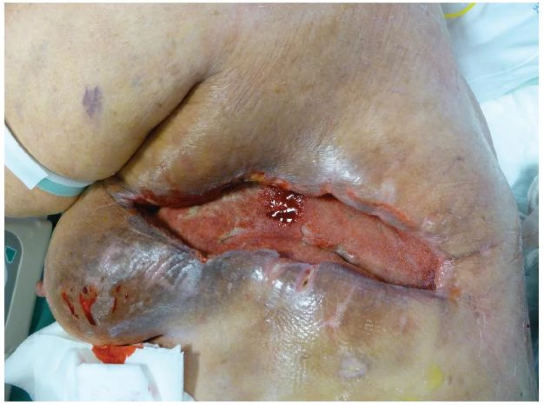 Stav rány po 6 týdnech podtlakové terapie
Fig. 5: The condition of the wound after 6 weeks of NPWT