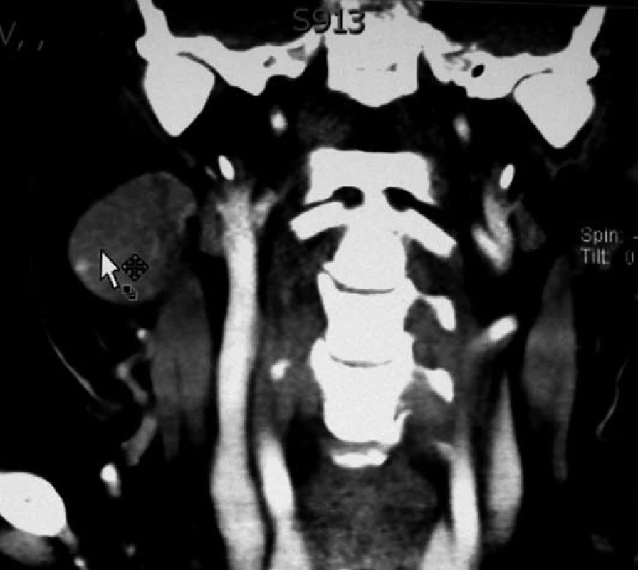 CT vyšetření s intravazálním kontrastem prokázalo tumor velikosti švestky pod pravým čelistním
úhlem