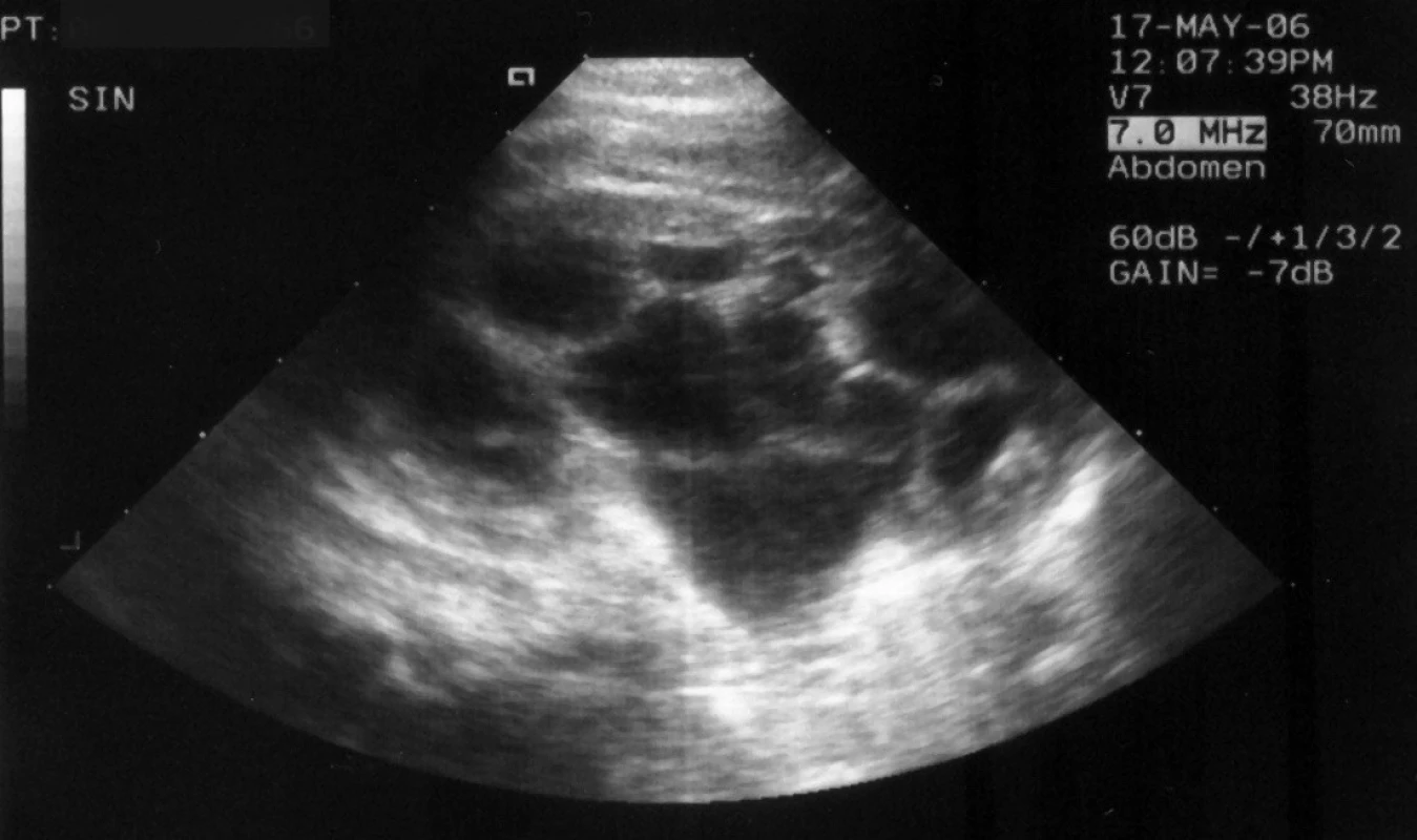 Kazuistika č. 1. UZ levé ledviny v 6 týdnech věku: progrese dilatace kalichopánvičkového systému levé ledviny, pánvička APIR 18 mm, horní kalich 16 mm, redukce parenchymu na 4 mm.
Fig. 1. Case report 1. US of the left kidney at 6 weeks of age: progressing dilatation of calix-pelvic system of the left kidney, pelvis APIR 18 mm, upper calyx 16 mm, reduction of parenchyma to 4 mm.