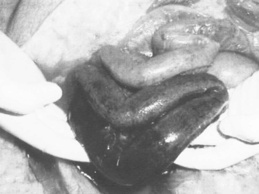 Gangréna tenkého čreva – venózny uzáver
Pic. 2. Gangrene of the small intestine – venous closure