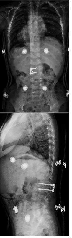 Pooperační zadopřední (a) a boční (b) rtg snímek pacientky ošetřené kombinovaným výkonem.
Fig. 2a, b. Postoperative anterior-posterior (a) and side (b) X-ray after the combined surgery.