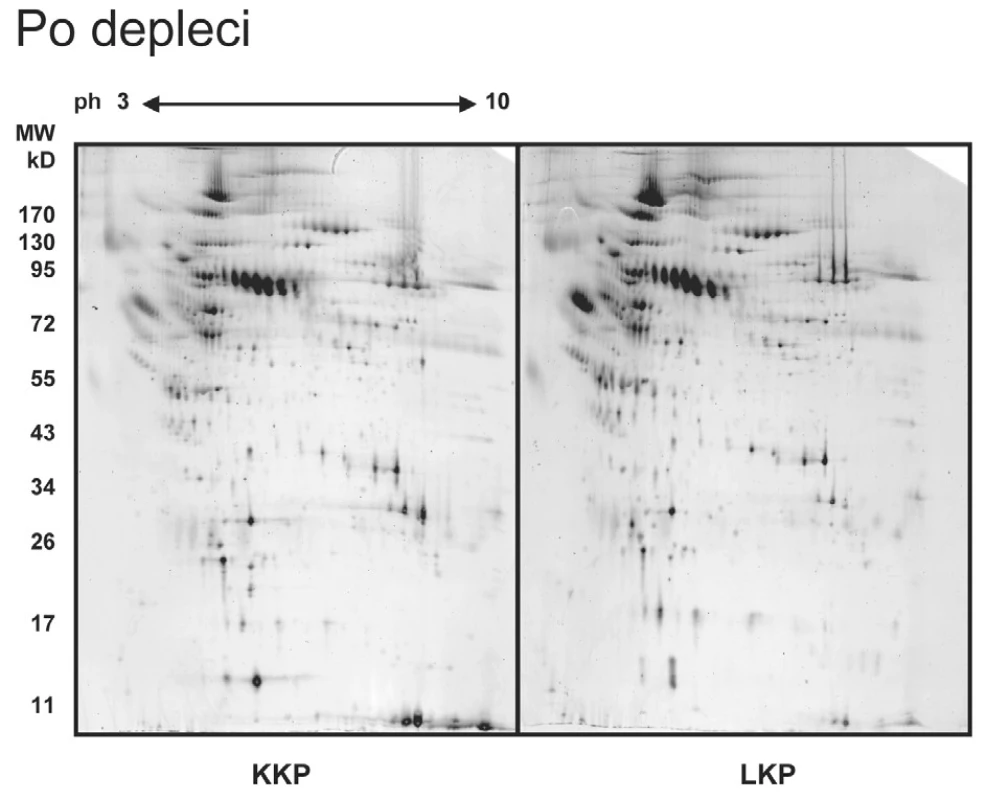 2-DE gel proteinů KKP a LKP po depleci albuminu a dalších majoritních proteinů. Gel barvený Sypro-ruby. Imunodeplece výrazně zvýšila množství minoritních proteinů ve srovnání s obr. 1. Počet identifikovaných skvrn stoupl na 393 (průměrný počet skvrn vyhodnocený na Master gelu).