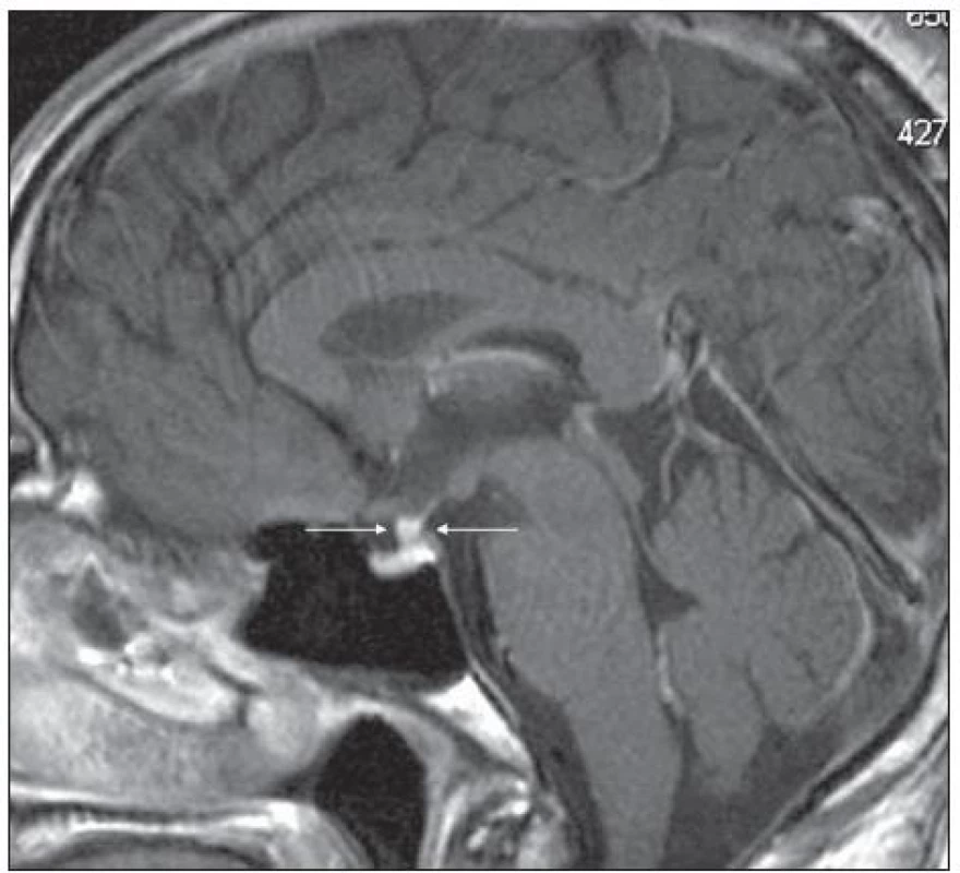 Pacient s Erdheimovou-Chesterovou chorobou (jako na obr. 5). MR mozku v roce 2006 postkontrastně se 
sytící ložiskové zbytnění stopky hypofýzy, T1 vážený obraz po aplikaci k.l., sagitální rovina.