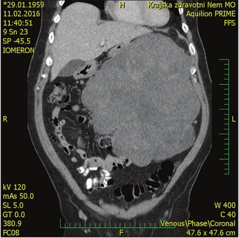 Předoperační CT břicha − koronární rovina
Fig. 2: Preoperative CT scan of the abdomen – coronal plane