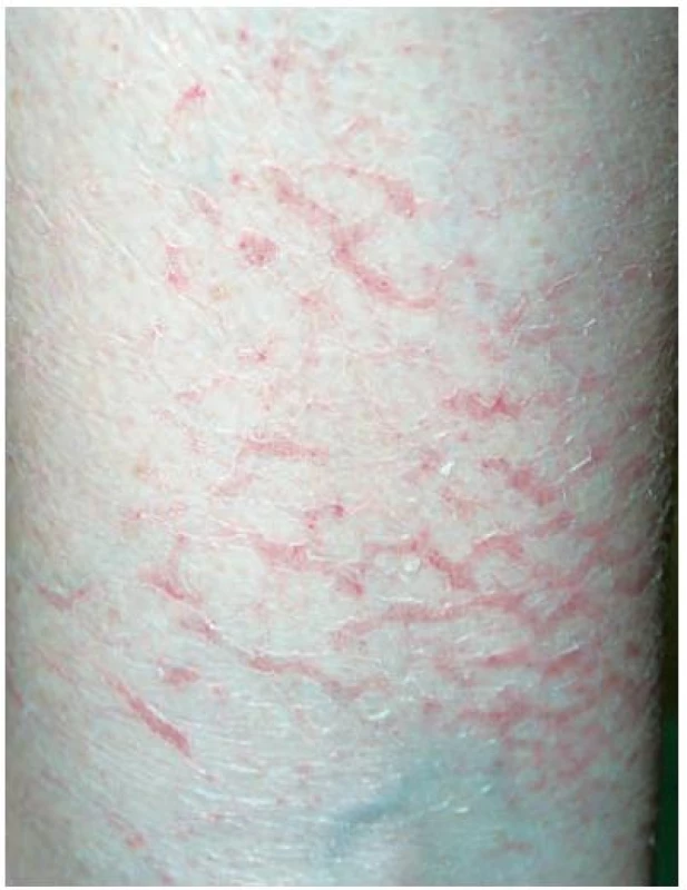 Asteatotický ekzém (eczema craquelé)