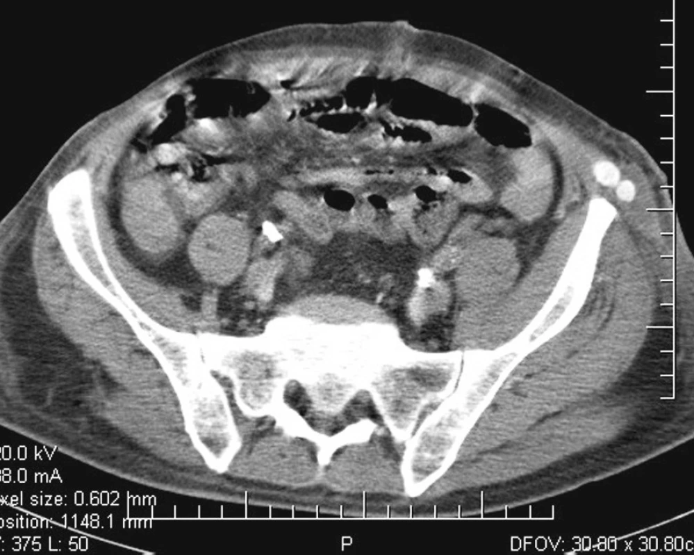 Pooperační CT: nejsou známky abscesu v malé pánvi. Laterálně vlevo v příčném řezu zachycená bifurkace průchodného axilobifemorálního bypassu
Fig. 4. Postoperative CT: there are no signs of an abscess in the pelvic cavity. Laterally left in a transverse slice, we can see the bifurcation of a patent axillo-bifemoral bypass