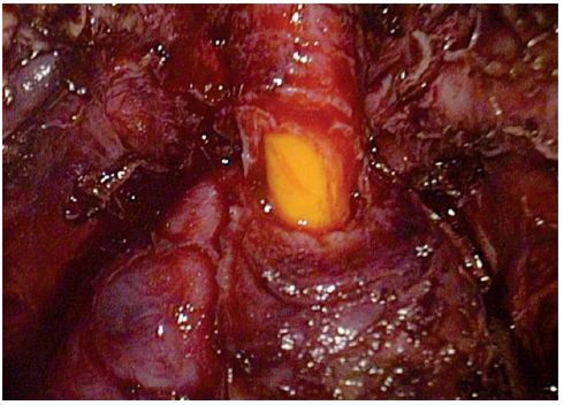 Odstřižení uretry
Fig. 6. The cut of the urethra