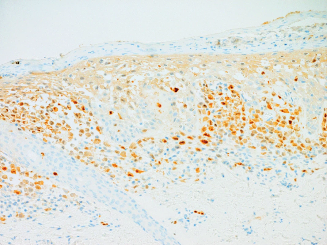 Pozitivní imunohistochemický průkaz S100 povrchového antigenu v nádorových buňkách, 200x zvětšeno.
Fig. 7. Positive imunohistochemical demonstration of S100 surface antigen in tumorous cells, 200x enlargement.