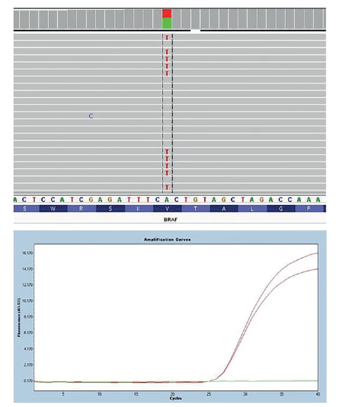 Detekce bodové mutace BRAF V600E
Na obrázku nahoře detekce pomocí masivně paralelního sekvenování a její vizualizace pomocí programu Integrative Genomic
Viewer (záměna nukleotidu A za T způsobující záměnu aminokyseliny valin za glutamát. Na obrázku dole detekce
pomocí alelicky specifického Real-Time PCR (červeně pacient s mutací BRAF V600E, zeleně negativní kontrola).<br>
Fig. 1: BRAF V600E point mutation detection
In the picture above, detection by massively parallel sequencing and its visualization using the Integrative Genomic Viewer
program (replacement of nucleotide A to T causing the amino acid substitution of valine for glutamate. control). In the figure
below, detection by allele-specific Real-Time PCR (red patient with BRAF V600E mutation, green negative control).