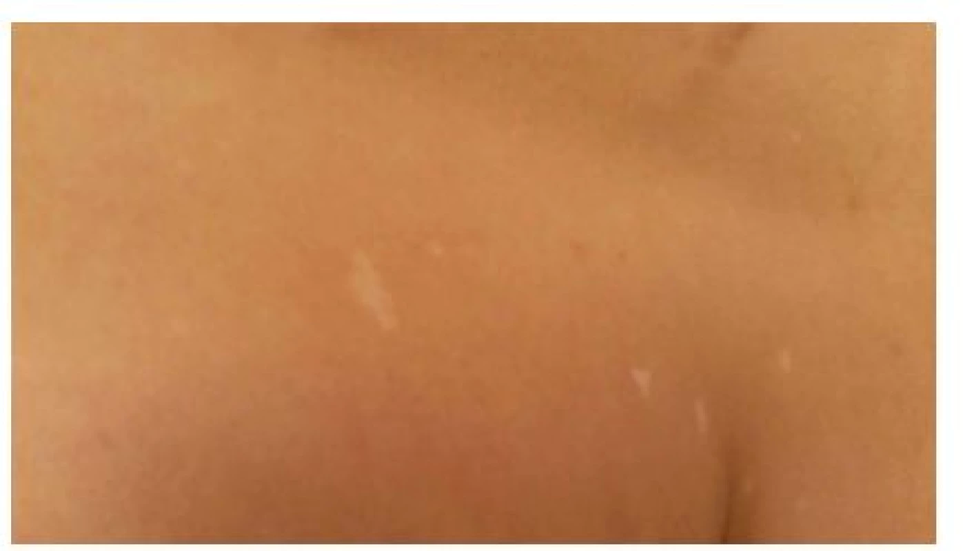 Drobné skvrnité depigmentace označované jako „confetti“ na trupu pacienta s tuberózní sklerózou