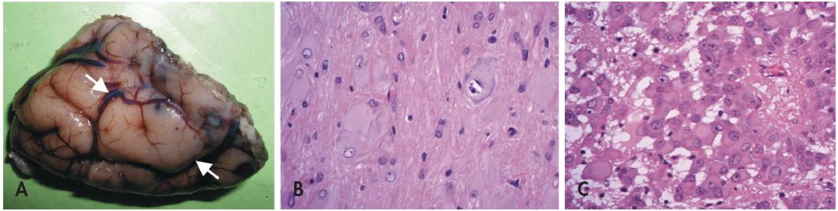 Tuberózní skleróza. Oblast korového tuberu imponuje makroskopicky jako tužší oploštělá oblast s poruchou gyrifikace (A). Pro kortikální tuber je mikroskopicky charakteristická přítomnost jednak obrovských dysmorfních neuronů, jednak bizarních buněk s obšírnou eozinofilní cytoplazmou (B). Subependymální obrovskobuněčný astrocytom (SEGA)(C) je benigní nádor rostoucí ve stěně laterálních komor mozku. Je tvořený atypickými velkými astrocyty epiteloidního vzhledu s bohatou eozinofilní cytoplazmou.