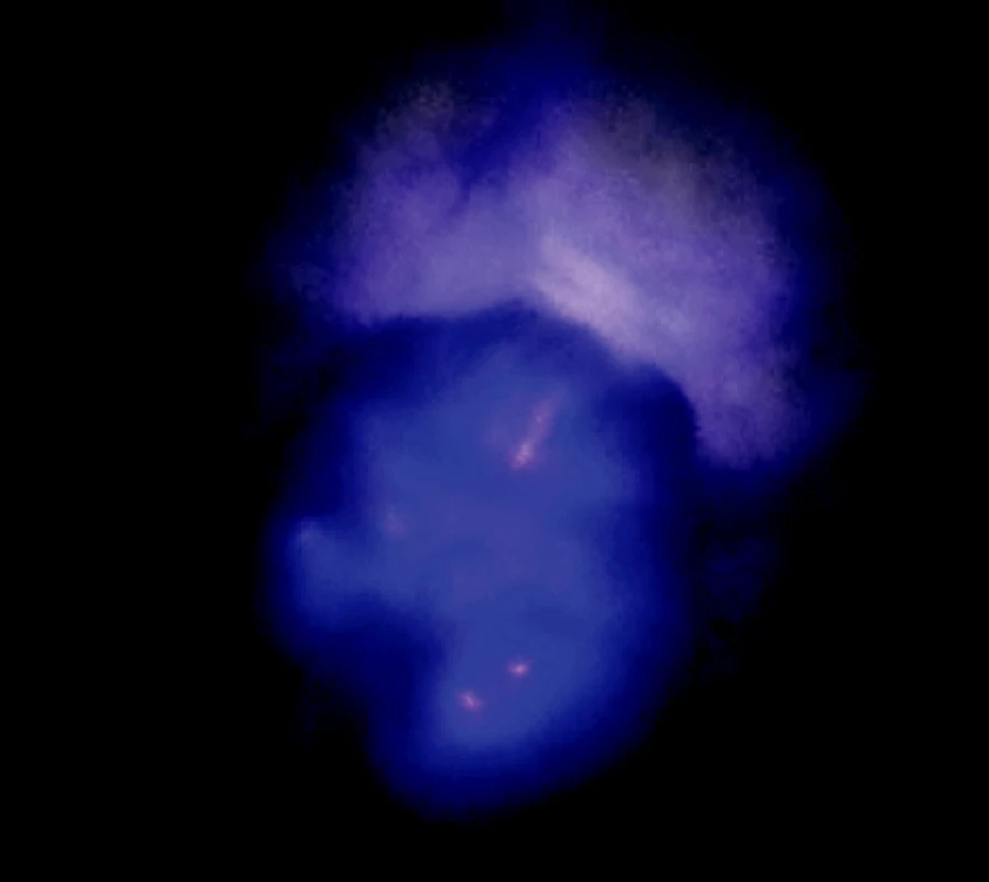 Ložisko adenokarcinómu v autofluorescenčnom obraze
Fig. 4. An autofluorescence view of the adenocarcinoma focus