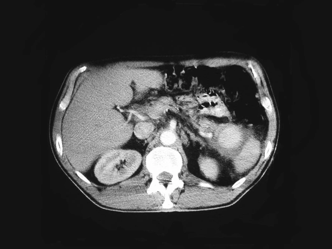 Kontrastní CT sken s průkazem promývaného pseudoaneuryzmatu po narušení slezinné tepny v prosinci 2004
Fig. 2. Contrast CT scan demonstrating a contrast-filled pseudoaneurysm resulting from the splenic artery invasion in December 2004