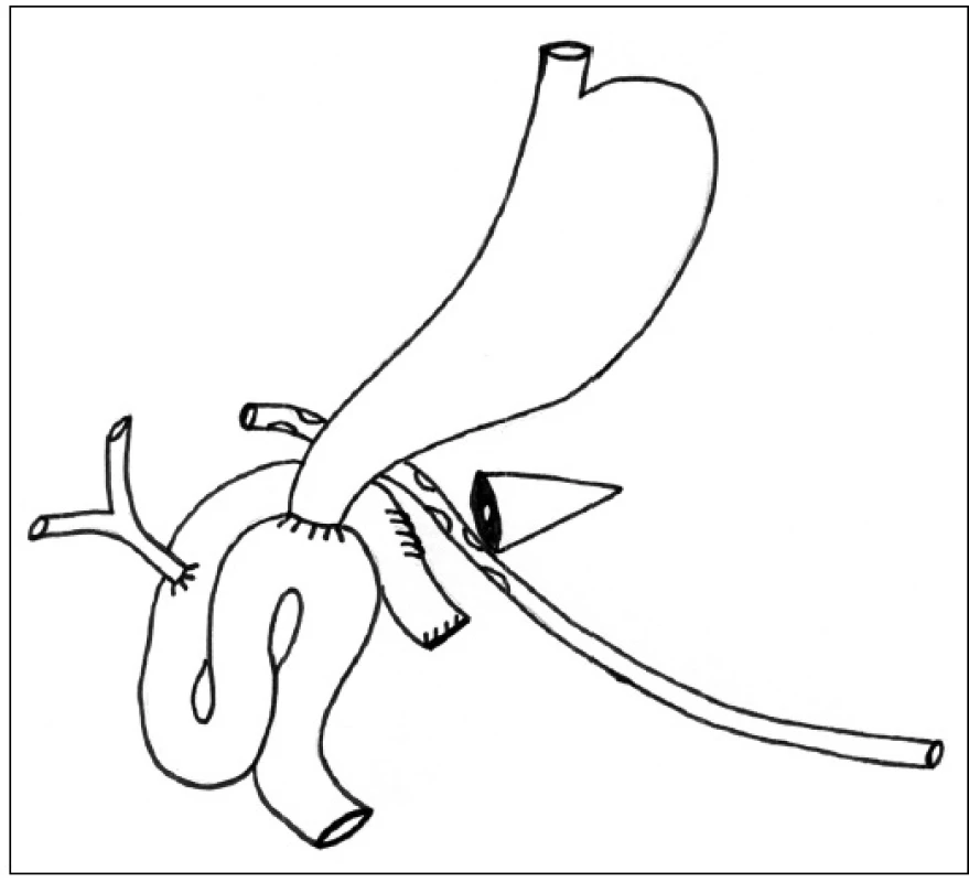 Ošetření pankreatické píštěle dekonexí PJA a retrogastrickou drenáží zbytku pankreatu
Fig. 2: Pancreatic fistula management with PJA disconnecting and retrogastric drainage of the pancreatic remnant
