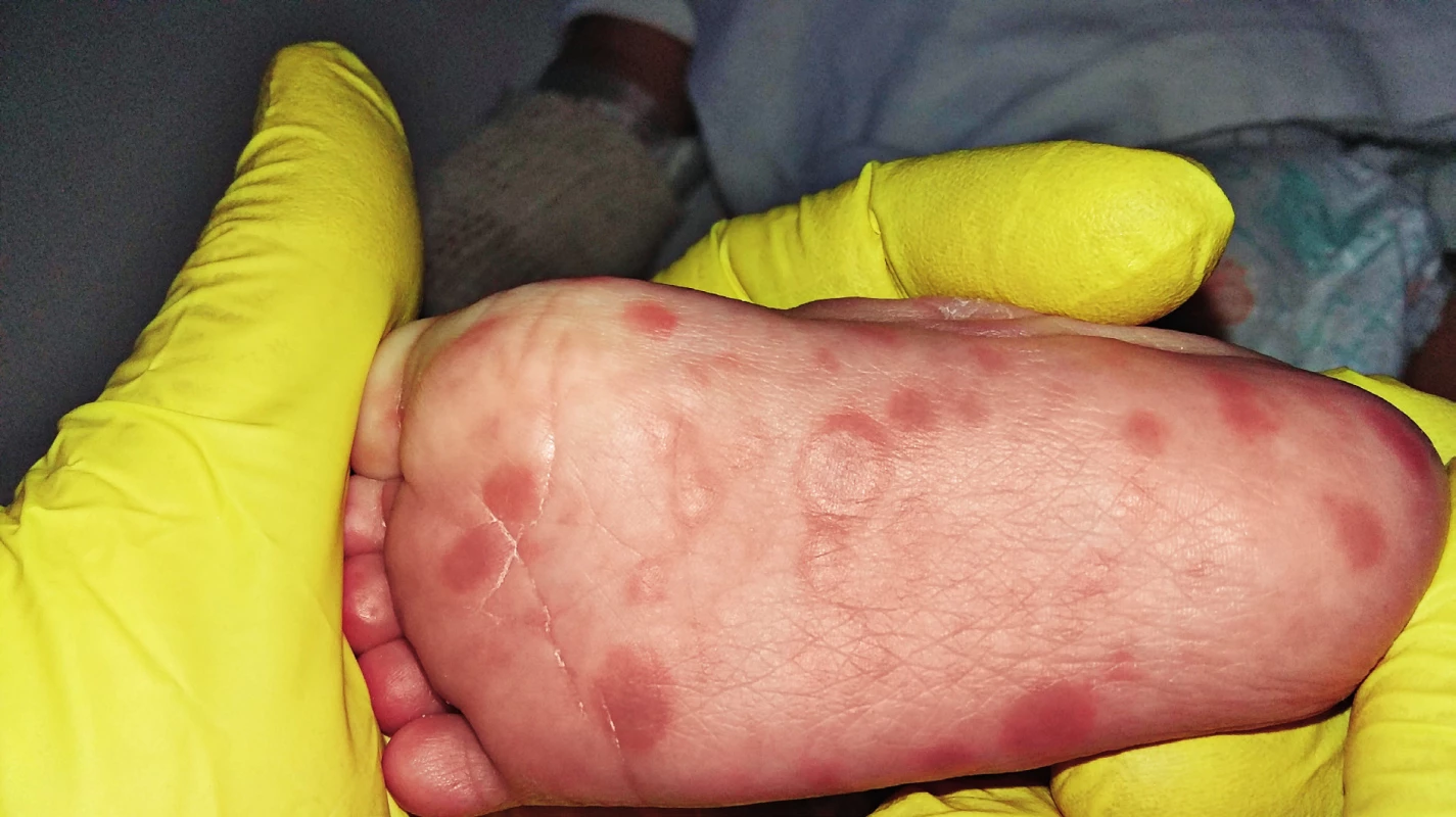 Detail plantárních syfilitických kožních lézí.
Fig. 2. Detail of plantar syphilitic skin lesions.