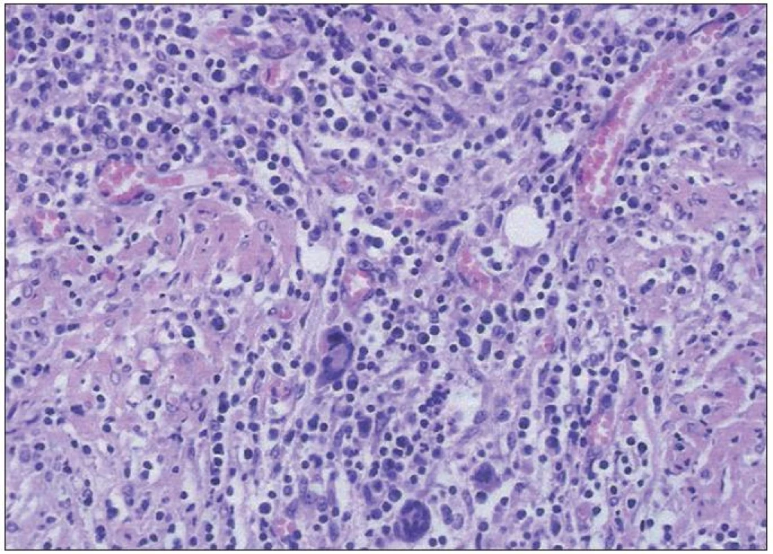 Detail predošlého obrazu: nápadne pleomorfná lymfohistiocytová populácia na pozadí chronického fibrotizujúceho zápalu (HE, 40krát).