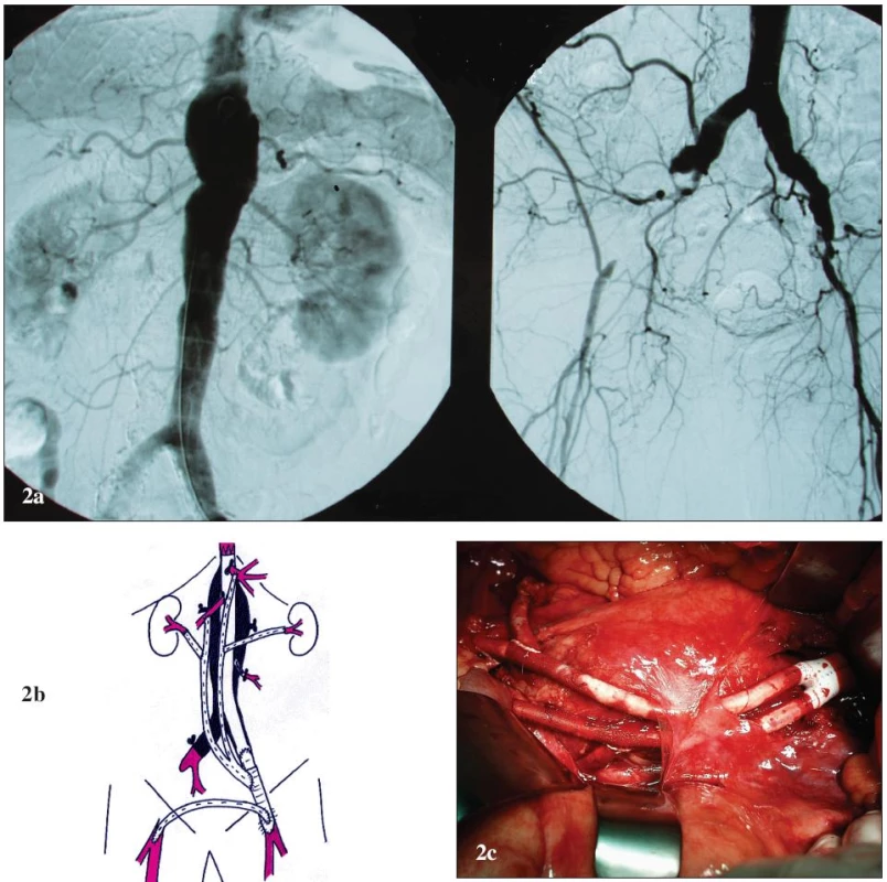 Muž 55 let s vysokým operačním rizikem a TAAA IV
2a: Předoperační angiografie. Výduť začíná v oblasti bránice, zaujímá odstupy viscerálních a renálních tepen a zasahuje do bifurkace aorty. AIE jsou oboustranně obliteračně postiženy (vpravo je tepna uzavřena, vlevo stenotická). 2b: Schéma kombinované léčby. K zavedení stentgraftu a k zajištění přítoku pro revaskularizaci je založen ilikofemorální bypass vlevo. Ke kompletní extraanatomické retrográdní revaskularizaci je použita obrácená bifurkační protéza (tělo protézy je našito na protézu ilikofemorálního bypassu); levé raménko pro TC, pravé raménko pro AMS, s odstupy pro AR. Centrálně jsou vyřazené aortální větve uzavřeny pomocí ligatury. Výduť je exkludována pomocí tubulárního aortouniiliakálního stentgraftu. Pravá dolní končetina je revaskularizována extraanatomicky pomocí zkříženého femoro-femorálního bypassu. 2c: Peroperační pohled. Laparotomie, otevřený zadní list peritonea, obrácená bifurkační protéza s odstupy pro AR.
Fig. 2. Male, aged 55, with a high operative risk and TAAA IV
2a: Pre-operative angiography. The aneurysm starts in the diaphragm area, involves the origins of the visceral and renal arteries and extends to the aortic bifurcation. EIA is bilaterally affected by obliteration (the artery is closed on the right and stenosed on the left). 2b: Combined treatment drawing. An iliac-femoral bypass is created on the left to allow stent-graft introduction and inflow for revascularisation. A reversed bifurcated prosthesis is used for complete extra-anatomical retrograde revascularization (the prosthesis body is sutured to the iliac-femoral bypass prosthesis); the left limb for CT, right limb for SMA, with prosthesis interponates for RA. The excluded aortic branches are centrally closed by ligation. The aneurysm is excluded using a tubular aorto-uniiliac stent-graft. The right lower extremity is revascularised using a cross over femoro-femoral bypass. 2c: Per-operative view. Laparotomy, opened posterior peritoneal lamina,
reversed bifurcated prosthesis with prosthesis interponates for RA. 