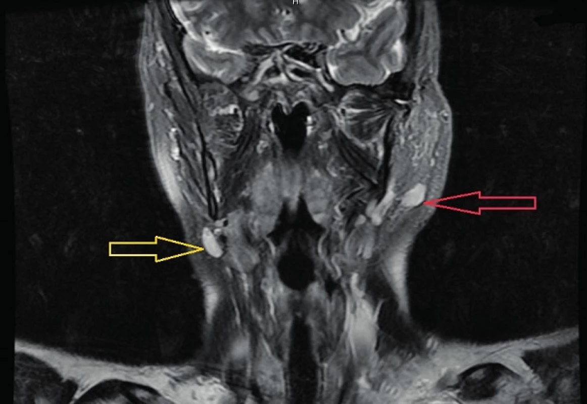 MRI zobrazení hlavy a krku v T2 váženém obrazu.
Frontální rovina – červená šipka zobrazuje ovoidní útvar v L příušní slinné žláze, solidní struktury vysokého signálu. Žlutá šipka označuje uzlinu.