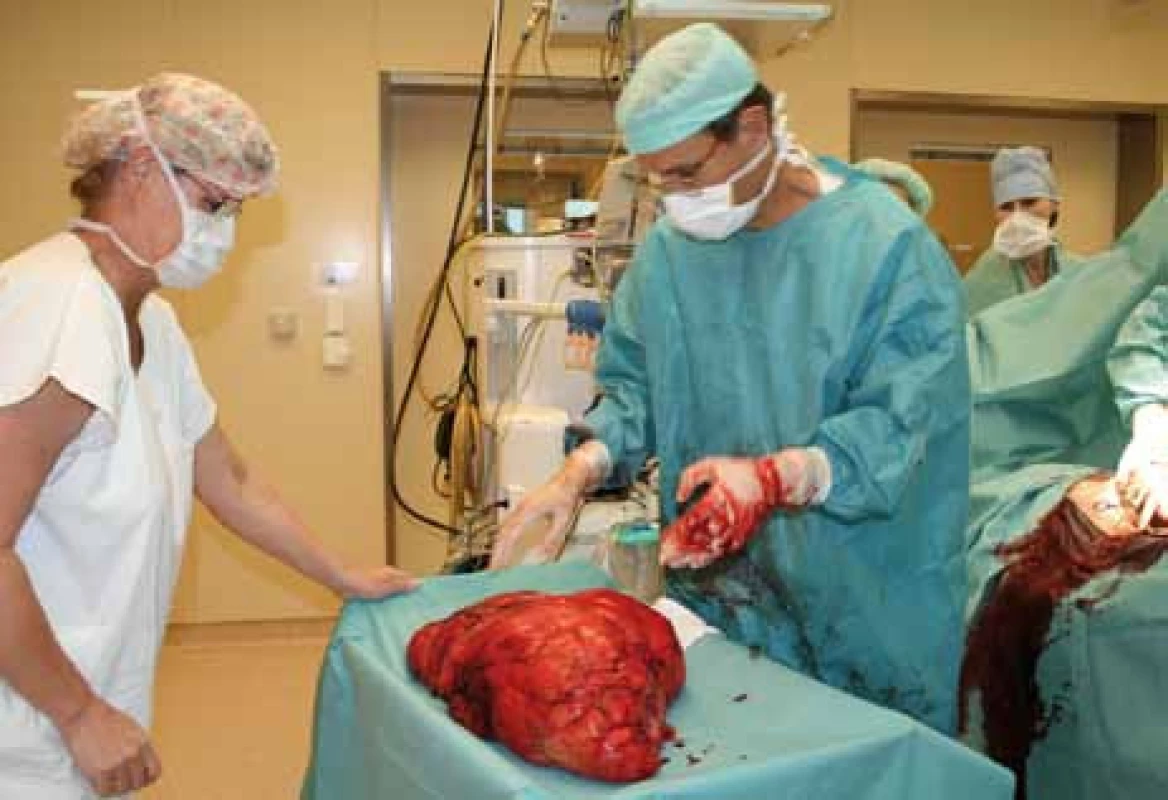 Fotografie tumoru na operačním sále.