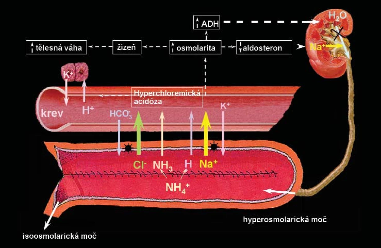 Navrhovaný mechanismus vzniku hyperchloremické acidózy u pacientů s ortotopickou neovezikou ze segmentu kolon. Sliznice kolon aktivně transportuje NaCl z moči do krevního řečiště – následováno pasivním transportem H&lt;sub&gt;2&lt;/sub&gt;0 – následně vzniká hyperchloremická acidóza a retence tekutin. Ačkoliv tento mechanismus nebyl ještě zcela objasněn, acidóza je vyvolána také absorpcí chloridu amonného.
Otištěno se svolením.
ADH – antidiuretický hormon, H&lt;sub&gt;2&lt;/sub&gt;0 – voda, Na&lt;sup&gt;+&lt;/sup&gt;– sodík, H&lt;sup&gt;+&lt;/sup&gt;– vodík, K&lt;sup&gt;+&lt;/sup&gt;– draslík, Cl&lt;sup&gt;-&lt;/sup&gt; – chlor, HCO&lt;sub&gt;3&lt;/sub&gt;&lt;sup&gt;-&lt;/sup&gt; – hydrogenuhličitan sodný, NH3&lt;sup&gt;-&lt;/sup&gt; amoniak, NH4&lt;sup&gt;+&lt;/sup&gt;– amonium [34].