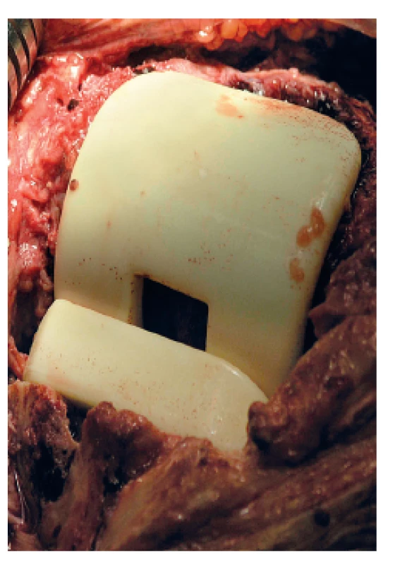 Peroperační snímek implantovaného kolenního spaceru Synicem&lt;sup&gt;®&lt;/sup&gt;
Fig 2. Perioperative photo of an implanted Synicem&lt;sup&gt;®&lt;/sup&gt; knee spacer