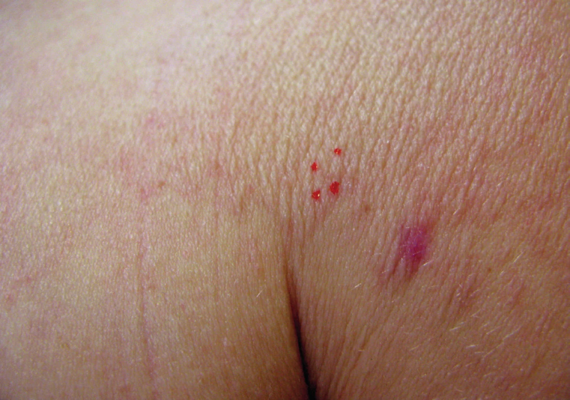 Hranice postižené kůže s jizvou po předchozí biopsii a označením biopsie opakované
