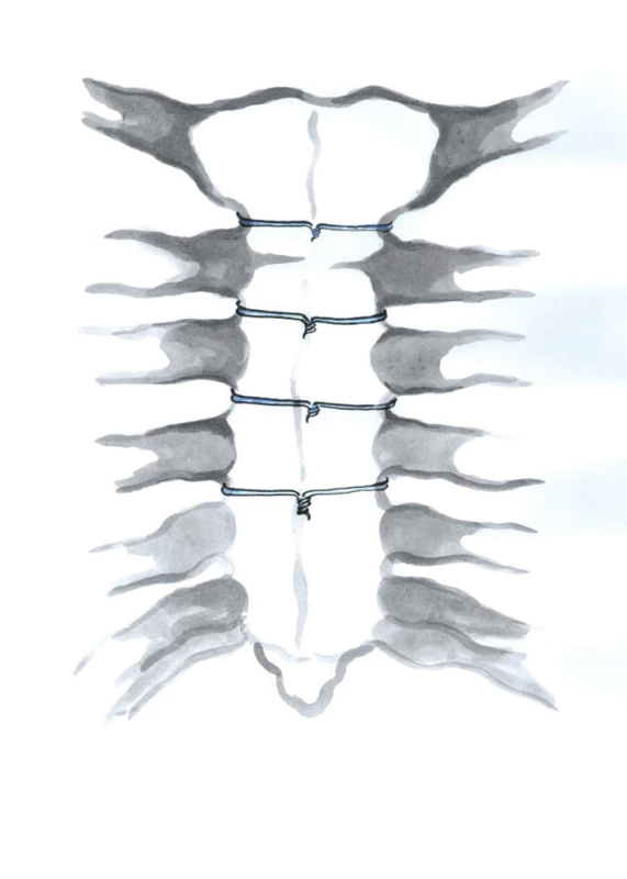 Technika uzávěru sternotomie jednotlivými peristernálními dráty (Kresba archiv autora)
Fig. 2: Single peristernal wire cerclage
