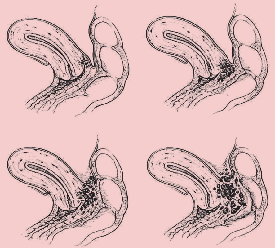 Klasifikace endometriózy rektovaginálního septa – Koninncky, Martin (1992).