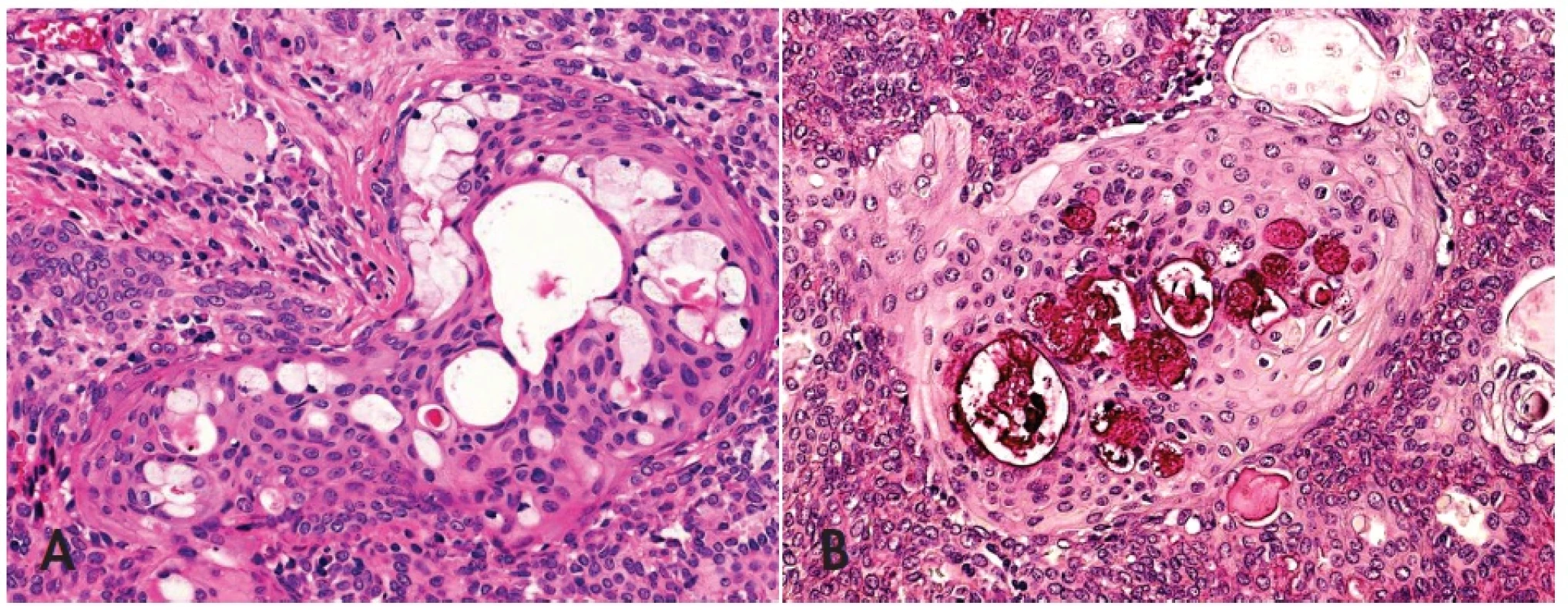 Skvamo-mucinózní metaplázie v pleomorfním adenomu napodobující mukoepidermoidní karcinom low grade (A), HE, 400x. Pohárkové buňky v barvení mucikarminem (B), 400x.
