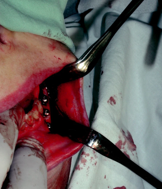 Situace v ústní dutině s dobře patrnými krycími šrouby na implantátech.