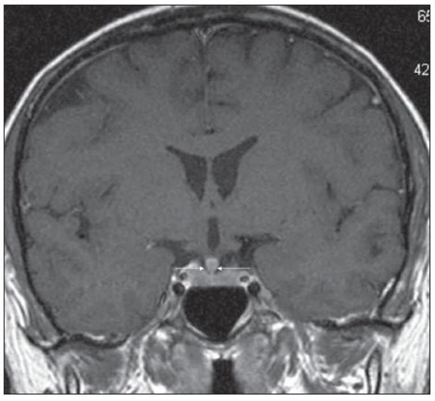 Pacient s Erdheimovou-Chesterovou chorobou (jako na obr. 5). MR mozku v červnu roku 2006: postkontrastně
se sytící ložiskové zbytnění stopky hypofýzy, T1 vážený obraz po aplikaci k.l., koronární rovina.
