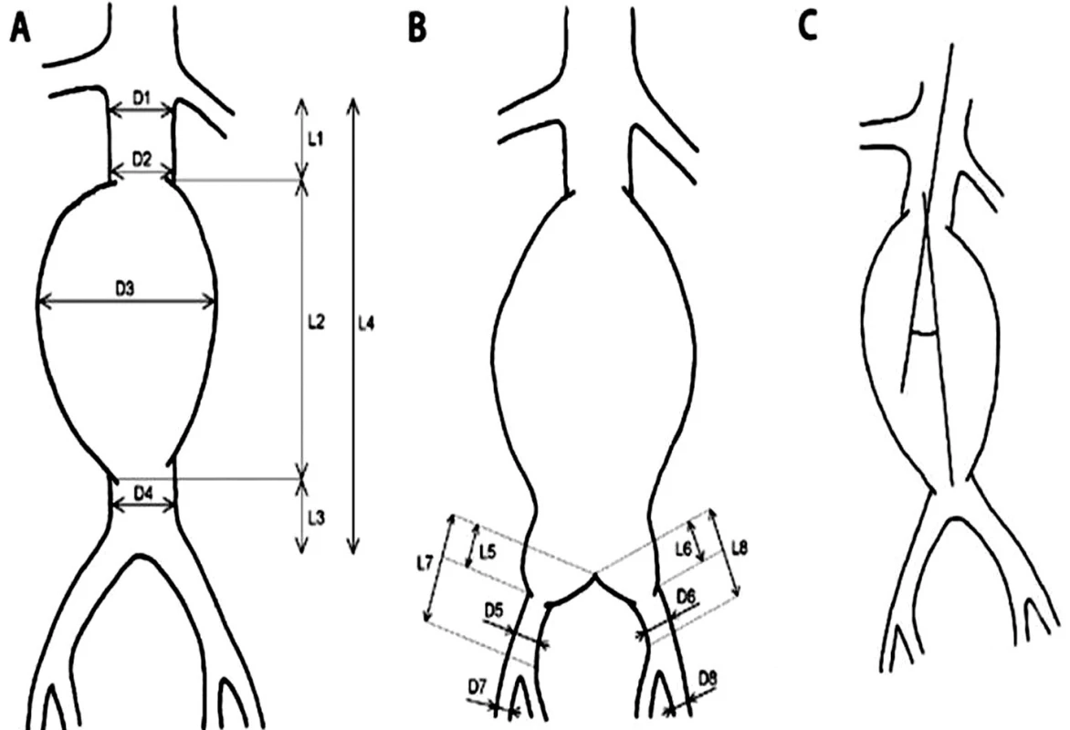 Schéma spôsobu merania vybraných parametrov infrarenálnej aorty s výduťou a iliakálneho riečiska A,B: D1 – priemer aorty (proximálneho krčka aneuryzmy) tesne pod odstupom distálne uloženej renálnej tepny, D2 – priemer aorty (proximálneho krčka aneuryzmy) tesne nad aneuryzmou, D3 – priemer aneuryzmy, D4 – priemer aorty (distálneho krčka, pokiaľ je prítomný) pod aneuryzmou, D5 – priemer „zdravého úseku“ AIC (arteria iliaca communis) pod aneuryzmou vpravo, D6 – priemer „zdravého úseku“ AIC pod aneuryzmou vľavo, D7 – priemer AIE (arteria iliaca externa) vpravo, D8 – priemer AIE vľavo, L1 – dĺžka proximálneho krčka aneuryzmy, L2 – dĺžka výdute, L3 – dĺžka distálneho krčka aneuryzmy (pokiaľ je prítomný), L4 – celková dĺžka subrenálnej aorty, L5 – dĺžka aneuryzmy postihnutého úseku AIC vpravo, L6 – dĺžka aneuryzmy postihnutého úseku AIC vľavo, L7 – dĺžka AIC vpravo, L8 – dĺžka AIC vľavo. C: uhol medzi pozdĺžnou osou proximálneho krčka a pozdĺžnou osou aneuryzmy.
Fig. 1: Diagram of the measurement method for selected parameters of infrarenal aortic aneurysm and iliac arteries A,B: D1 – aortic diameter (proximal aneurysm neck) just below the origin of distally located renal artery, D2 – aortic diameter (proximal aneurysm neck) just above the aneurysm, D3 – diameter of the aneurysm, D4 – aortic diameter (distal neck, if present) below the aneurysm, D5 – diameter of the “healthy segment” of AIC (common iliac artery) under the aneurysm on the right side, D6 – diameter of the “healthy segment” of AIC below the aneurysm on the left side, D7 – diameter of AIE (external iliac artery) on the right, D8 – diameter of AIE on the left, L1 – the length of the proximal neck of the aneurysm, L2 – the length of the aneurysm, L3 – the length of the distal neck of the aneurysm (if present), L4 – the total length of the infrarenal aorta, L5 – the length of the affected segment of the right AIC, L6 – the length of the affected segment of the left AIC, L7 – the length of the right AIC, L8 – the length of the left AIC. C: the angle between the longitudinal axis of the proximal neck and the longitudinal axis of the aneurysm.