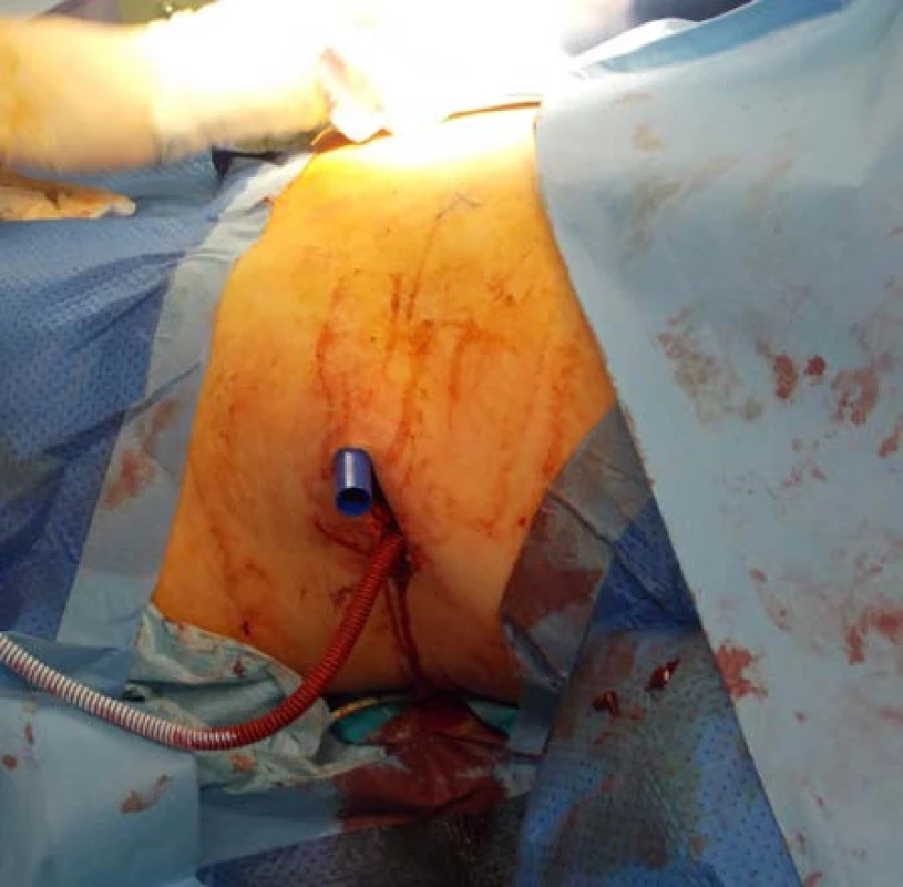 Příprava stentu k zavedení do tunelizátoru
Fig. 3. Preparation of the stent to insertion into the plastic hollow tube