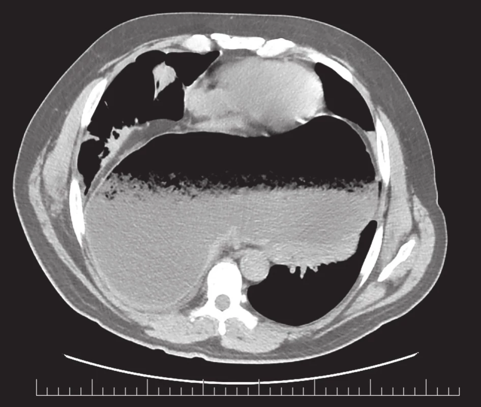 Vstupní CT (axiální řez), hiátová hernie
Fig. 2. Initial CT (axial cross-section), hiatal hernia