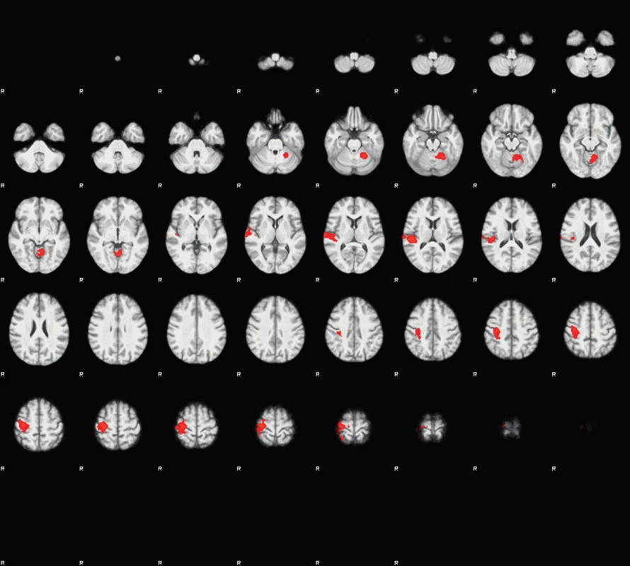 Průměrné skupinové aktivace na fMRI mozku při pohybu levým zápěstím, 6 měsíců po operaci krční páteře (Po terapii došlo vizuálně k významnému zmenšení rozsahu aktivací i maximálního Z-skóre ve většině oblastí.)
Fig. 2: Analysis of mean group effects in brain fMRI during movement of left wrists, six months after surgery. After surgical therapy, the cortical activations and maximum Z-scores decreased in most areas. (Background − T1-weighted scans with high resolution (sequences &gt;MPRAGE). Picture - statistical Z-maps -red (minimum), yellow (maximum).