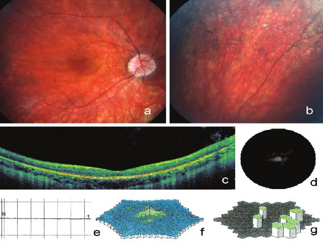 Klinické nálezy zjištěné na pravém oku u 22letého muže (IV:5) s retinitis pigmentosa podmíněnou mutací v ORF15 genu &lt;i&gt;RPGR&lt;/i&gt;. Na fotografii fundu je patrné prořídnutí retinálního pigmentového epitelu, zúžené arterie, bledý terč zrakového nervu a) a větší množství shluků pigmentu tvaru kostních buněk b), vertikální SD-OCT makuly dokumentuje sníÏení tloušťky neuroretiny a tenkou cévnatku se zvýrazněním jejích struktur při úbytku RPE c). Koncentrické zúžení zorného pole d), vyhaslá tyčinková odpověď e), snížení hustoty odpovědí na trojrozměrném obraze při multifokální ERG f), zbytkové oblasti elektrické aktivity sítnice představované zelenými šestiúhelníky g)