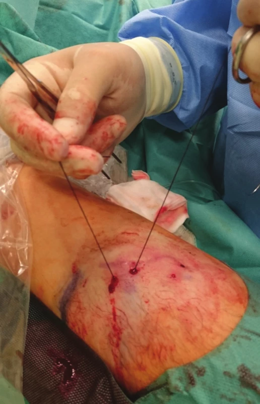 Provlečení nitě pod žilou
Fig. 2: The suture is drawn under the vein