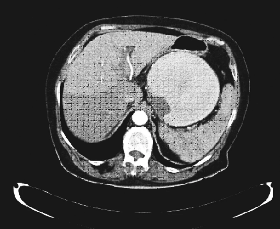 Obrovské aneuryzma lienální tepny (CT AG)
Fig. 1. A massive aneurysm of the lienal artery (CT AG)
