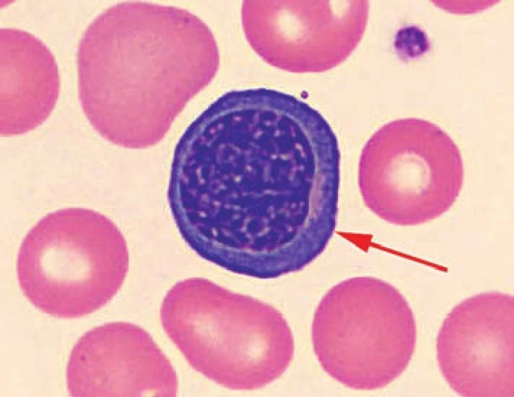Detail nátěru periferní krve pacienta č. 3 s nálezem jaderné erytroidní buňky.
Fig. 3. Detail of the patient’s peripheral blood smear No. 3 with finding of nucleated erythroid cells.