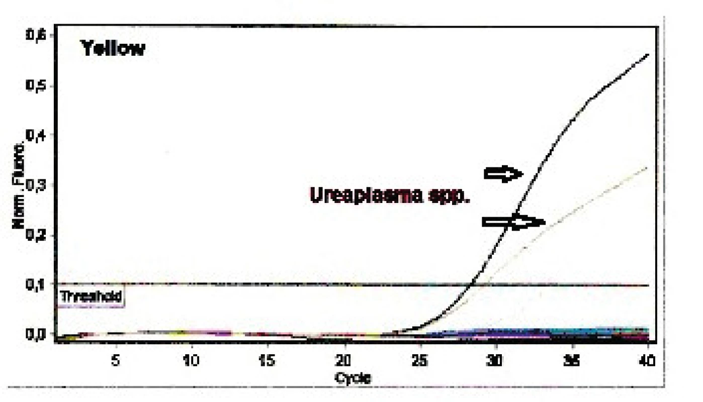 Výstup rt-PCR &lt;i&gt;Ureaplasma&lt;/i&gt; spp.