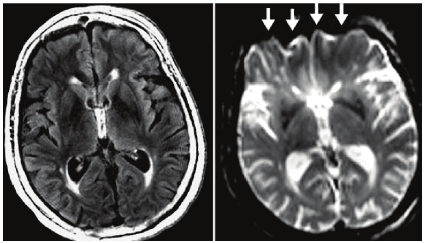 Artefakt skreslenia. Vľavo TSE FLAIR obraz. Vpravo na spin-echo-EPI obraze možno frontálne vidieť skreslenie, ktoré je spôsobné inhomogenitou magnetického poľa v oblasti čelových dutín [5].