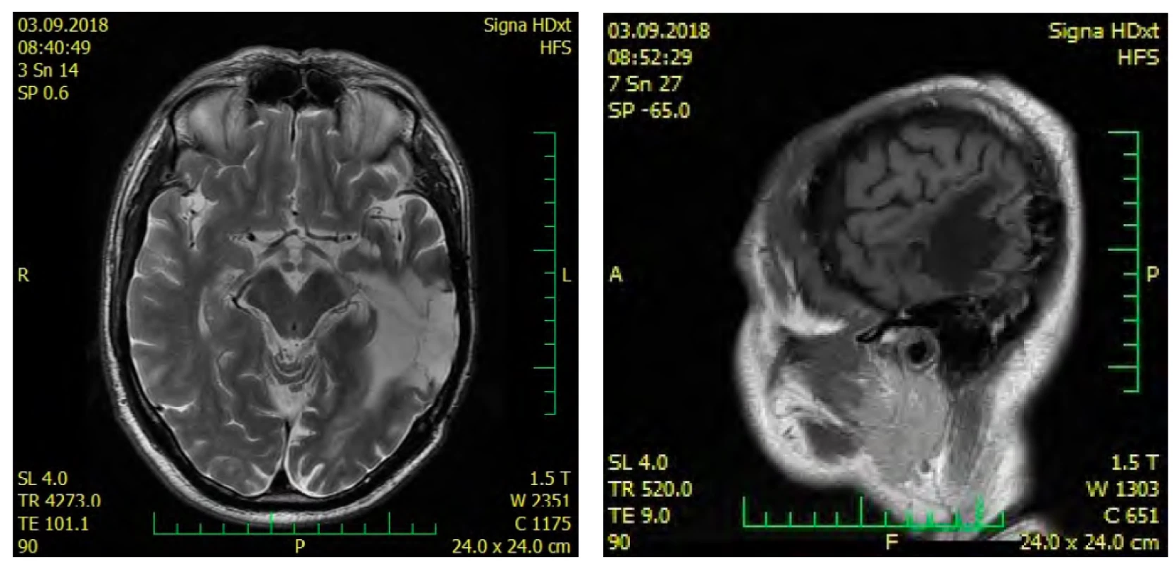 MRI po resekci astrocytomu v r. 2018 – na sagitálním řezu vpravo lze pozorovat přesah leze do dolní části parietálního laloku
