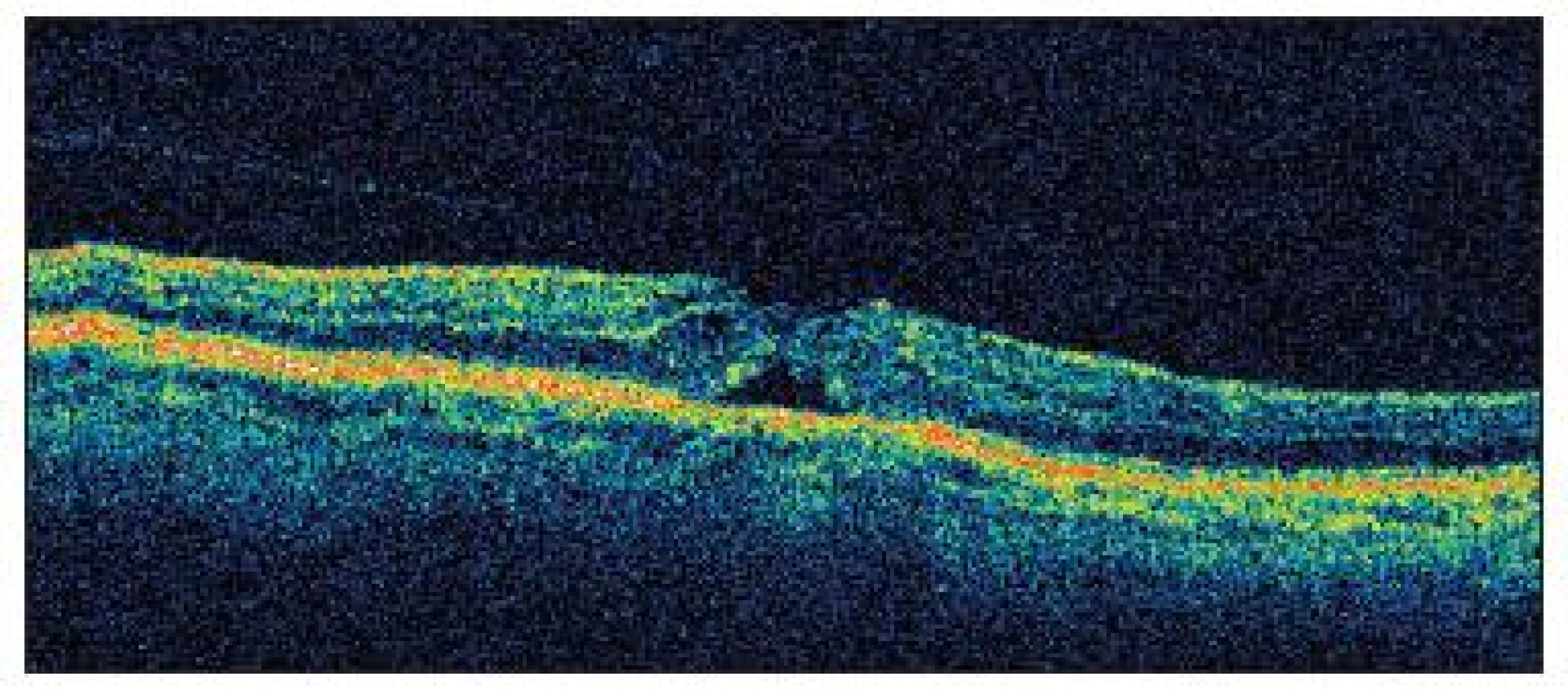 OCT nález u pacienta č.1 nasledujúci deň po operácii katarakty so zobrazením priblíženia okrajov neurosenzorickej sietnice a pravdepodobne s nakopením glie na vnútornom povrchu sietnice, stále je evidentná vitreoretinálna adhézia s trakciou