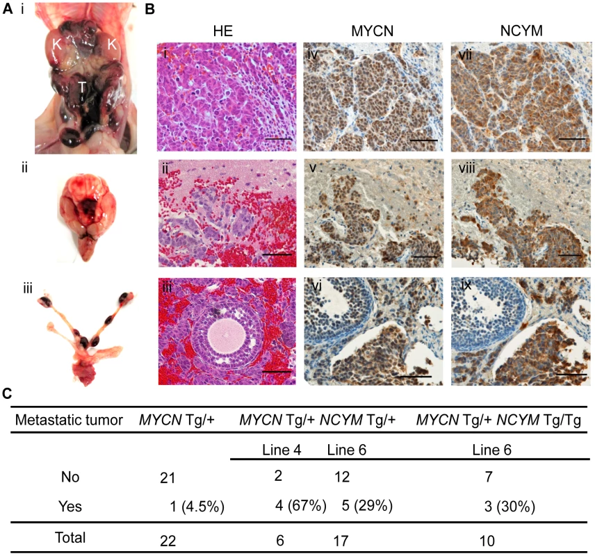 NCYM promotes metastasis in mouse transgenic models of neuroblastoma.