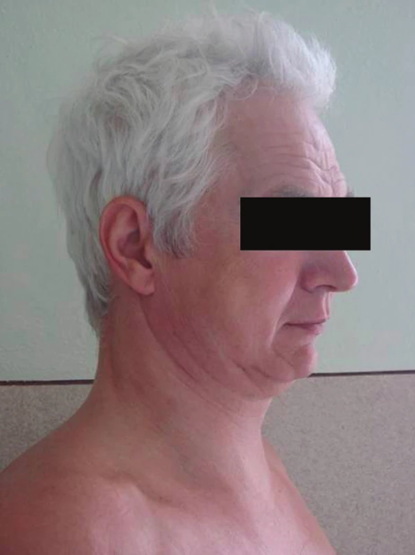 Pacient s podkožním emfysémem hrudníku a krku
Fig. 2. The patient with subcutaneous emphysema of the neck a thorax